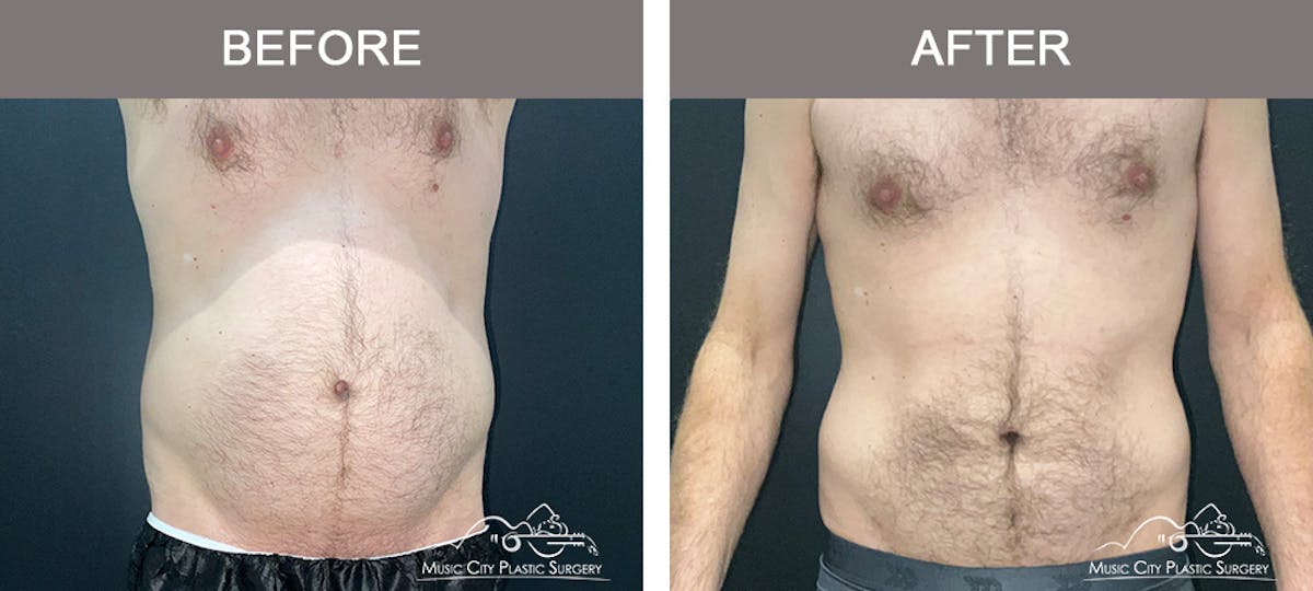 Male Liposuction Before & After Gallery - Patient 468244 - Image 1