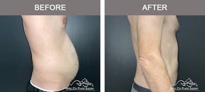 Male Liposuction Before & After Gallery - Patient 468244 - Image 3