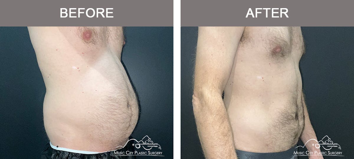Male Liposuction Before & After Gallery - Patient 468244 - Image 2