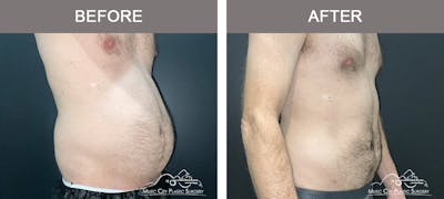 Male Liposuction Before & After Gallery - Patient 468244 - Image 2