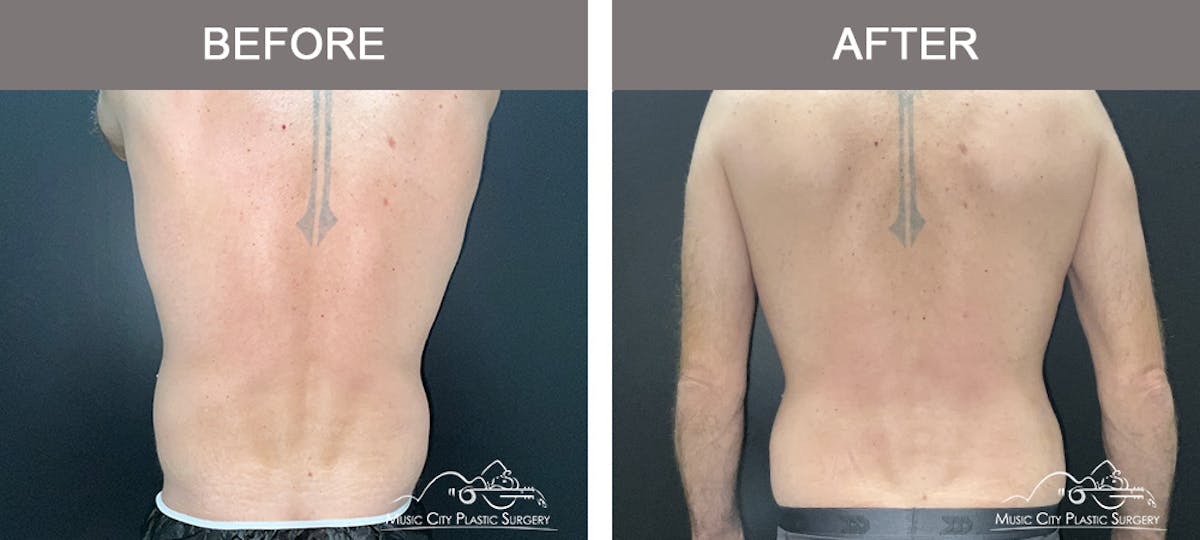 Male Liposuction Before & After Gallery - Patient 468244 - Image 5