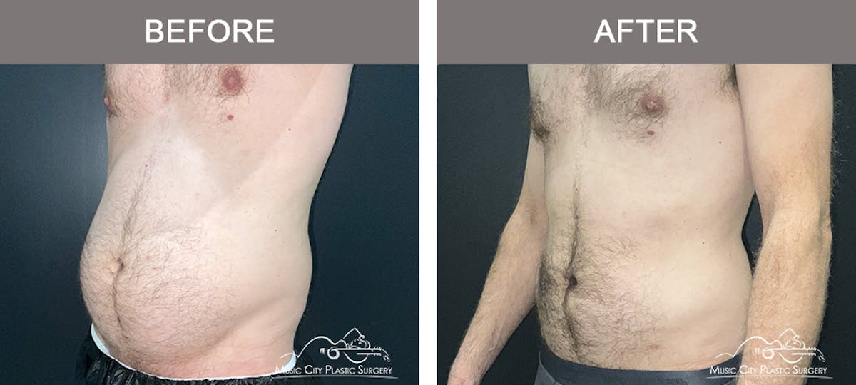 Male Liposuction Before & After Gallery - Patient 468244 - Image 4