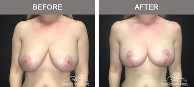 Breast Lift Before & After Gallery - Patient 230563 - Image 1