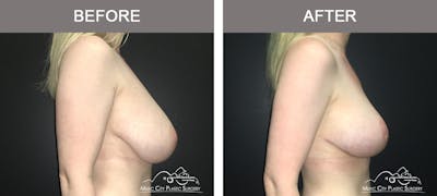Breast Lift Before & After Gallery - Patient 230563 - Image 3