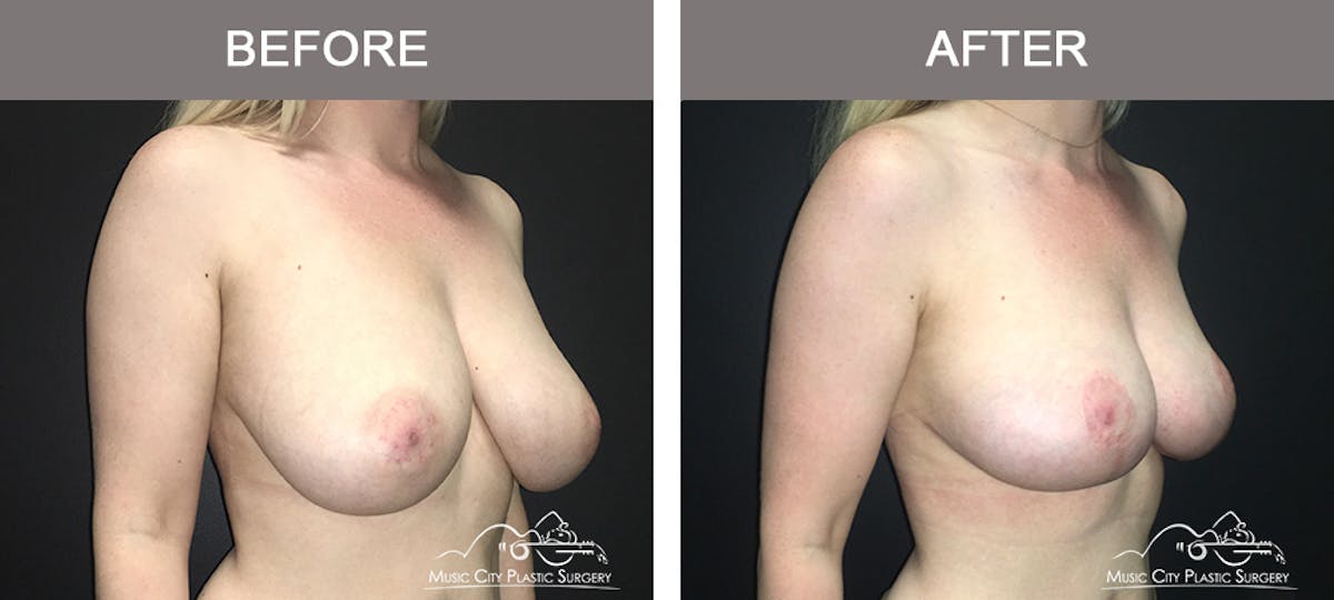 Breast Lift Before & After Gallery - Patient 230563 - Image 2