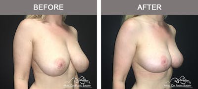 Breast Lift Before & After Gallery - Patient 230563 - Image 2