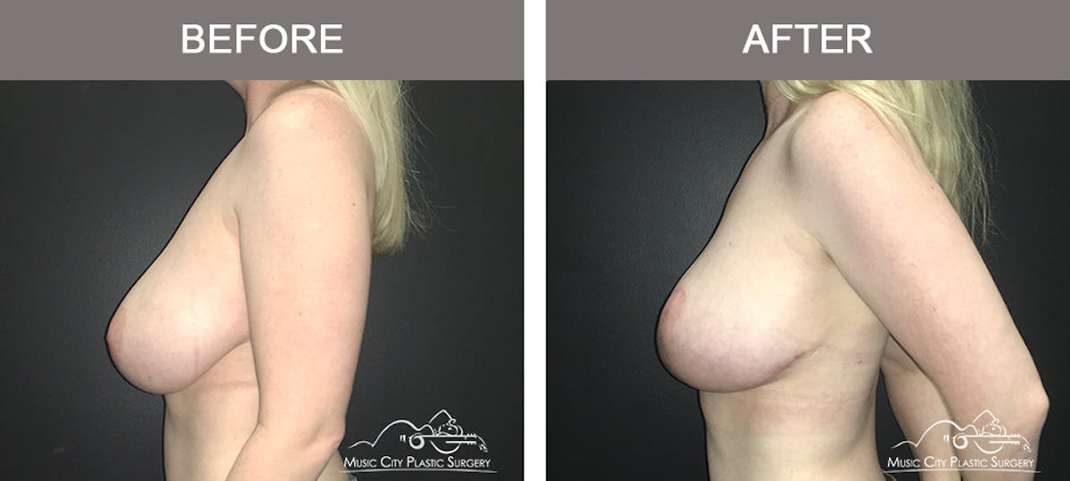 Breast Lift Before & After Gallery - Patient 230563 - Image 5
