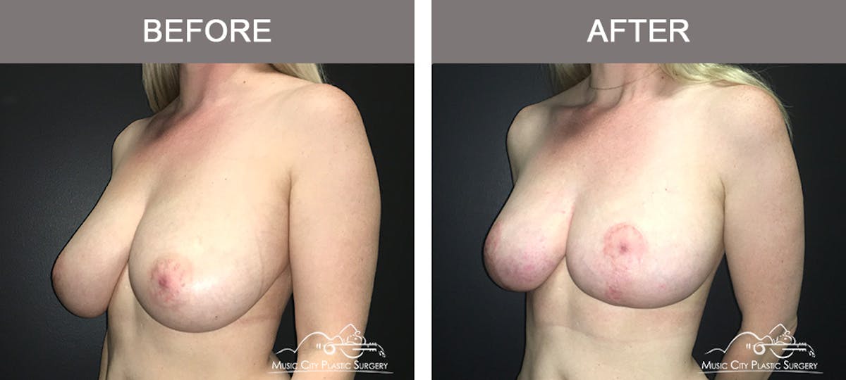 Breast Lift Before & After Gallery - Patient 230563 - Image 4