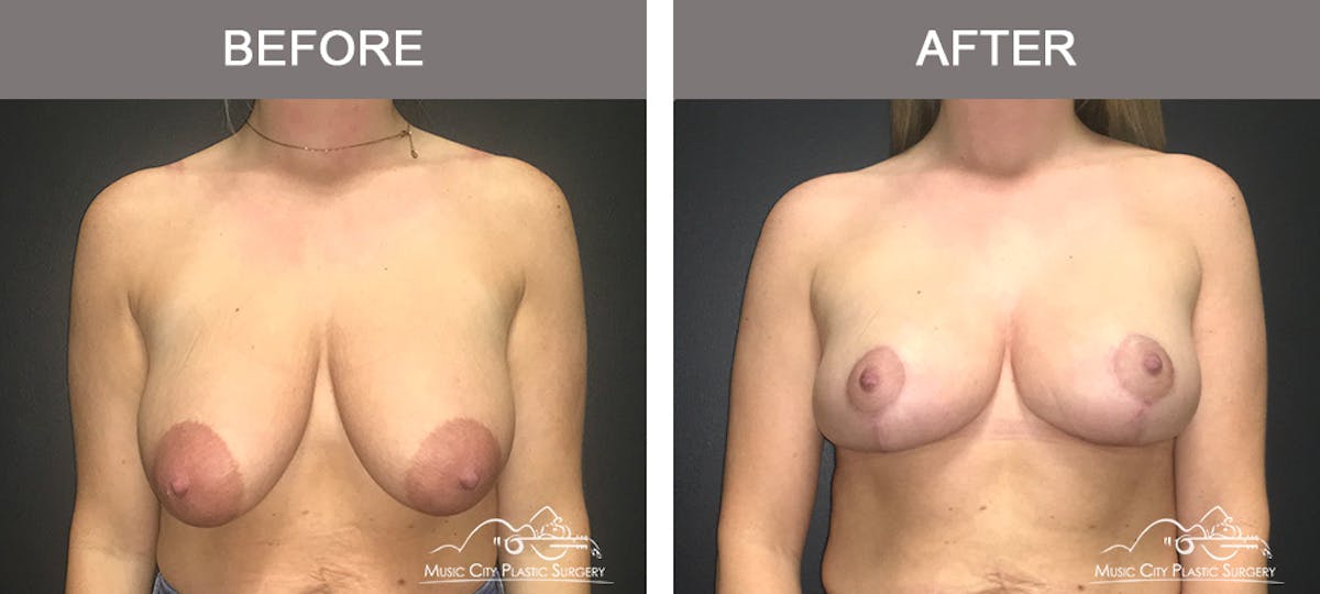 Breast Reduction Before & After Gallery - Patient 161928 - Image 1