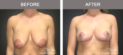 Breast Reduction Before & After Gallery - Patient 161928 - Image 1