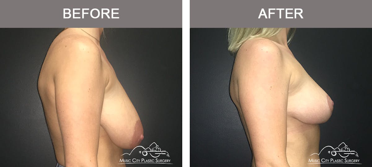 Breast Lift Before & After Gallery - Patient 262228 - Image 3