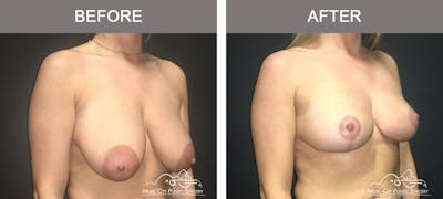 Breast Lift Before & After Gallery - Patient 262228 - Image 2
