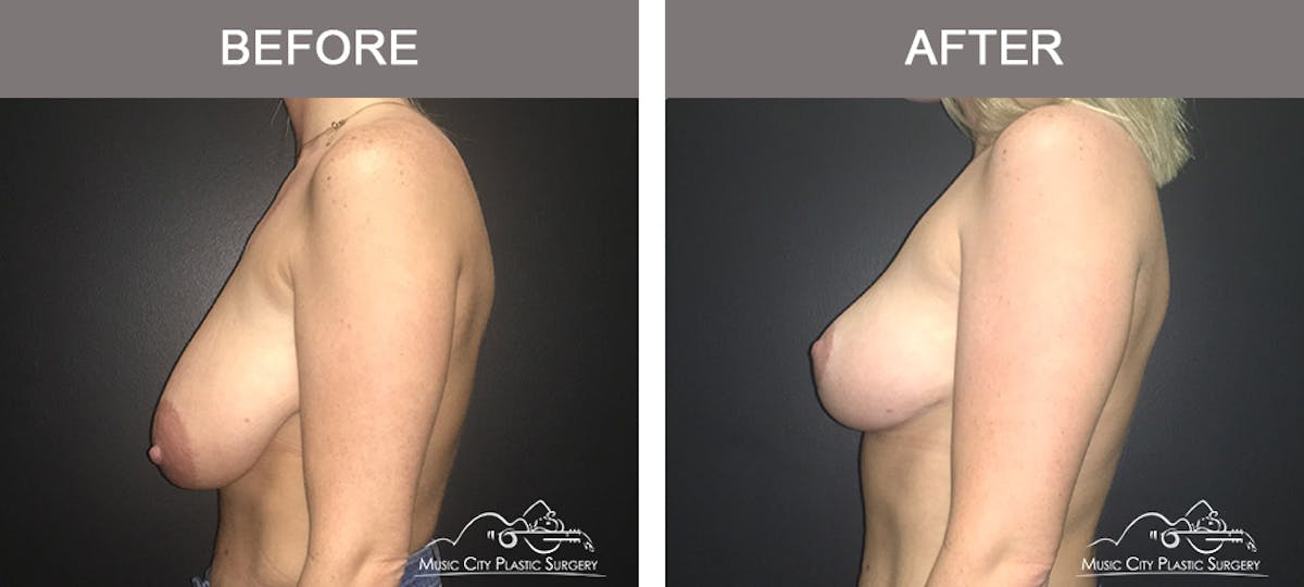 Breast Reduction Before & After Gallery - Patient 161928 - Image 5
