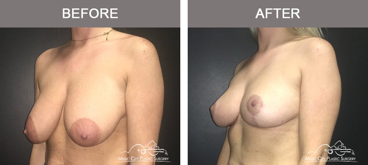 Breast Lift Before & After Gallery - Patient 262228 - Image 4