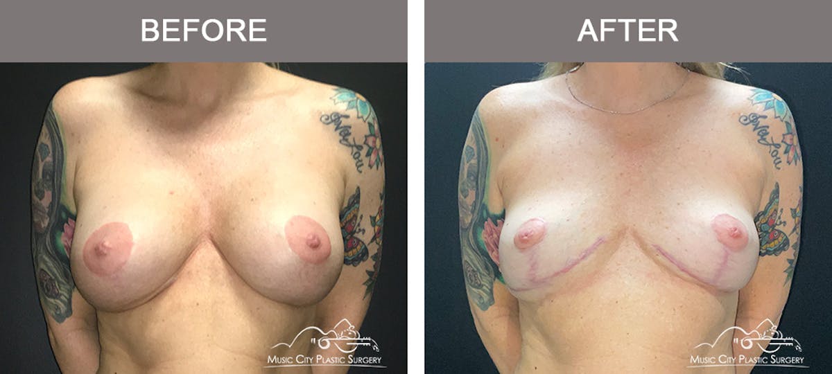 Capsulectomy Before & After Gallery - Patient 134864 - Image 1