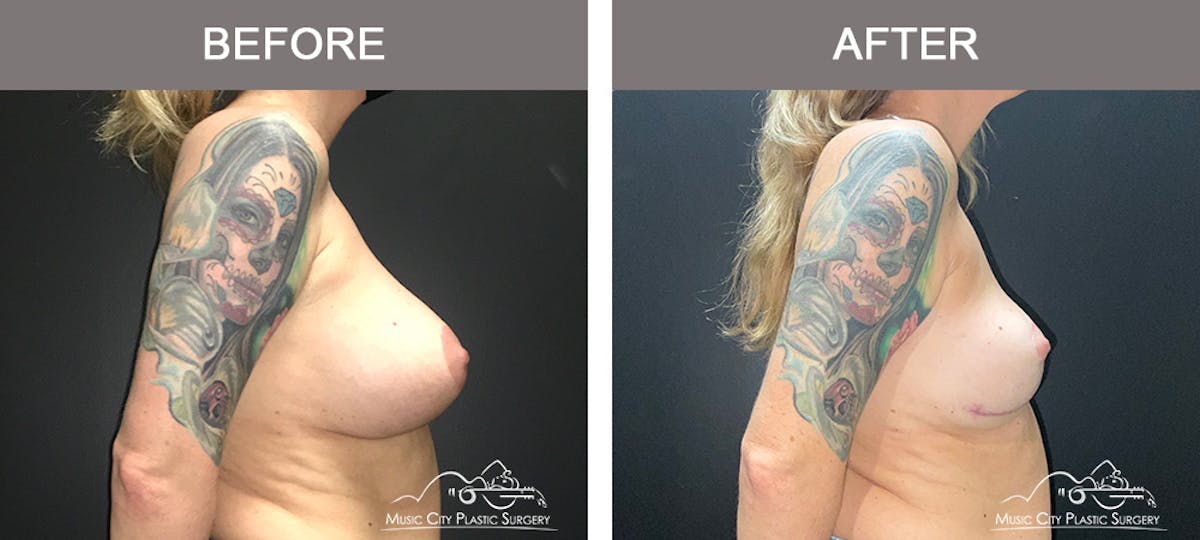 Capsulectomy Before & After Gallery - Patient 134864 - Image 3
