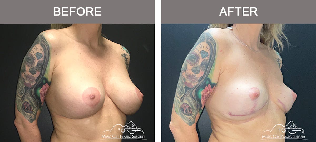 Capsulectomy Before & After Gallery - Patient 134864 - Image 2