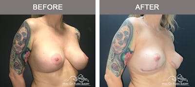 Breast Lift Before & After Gallery - Patient 353524 - Image 2