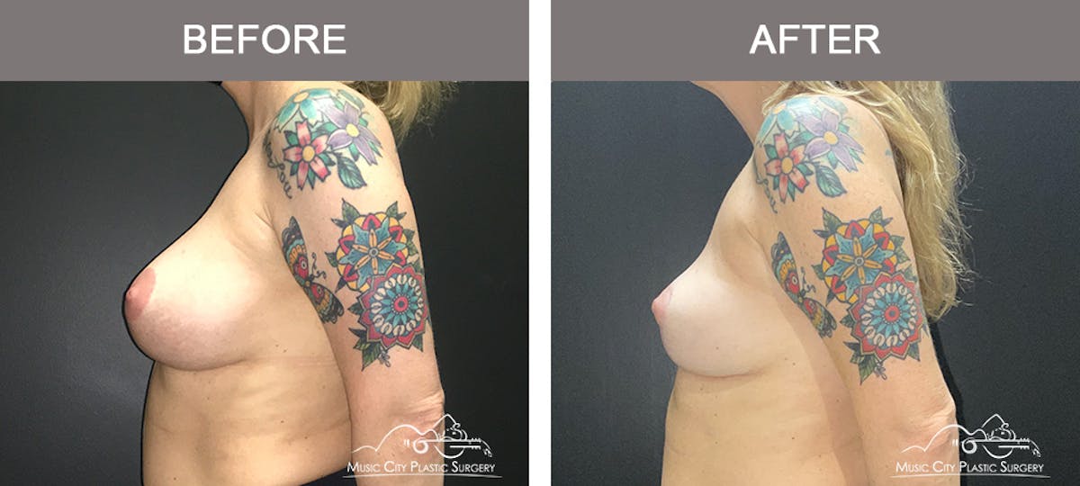 Capsulectomy Before & After Gallery - Patient 134864 - Image 5