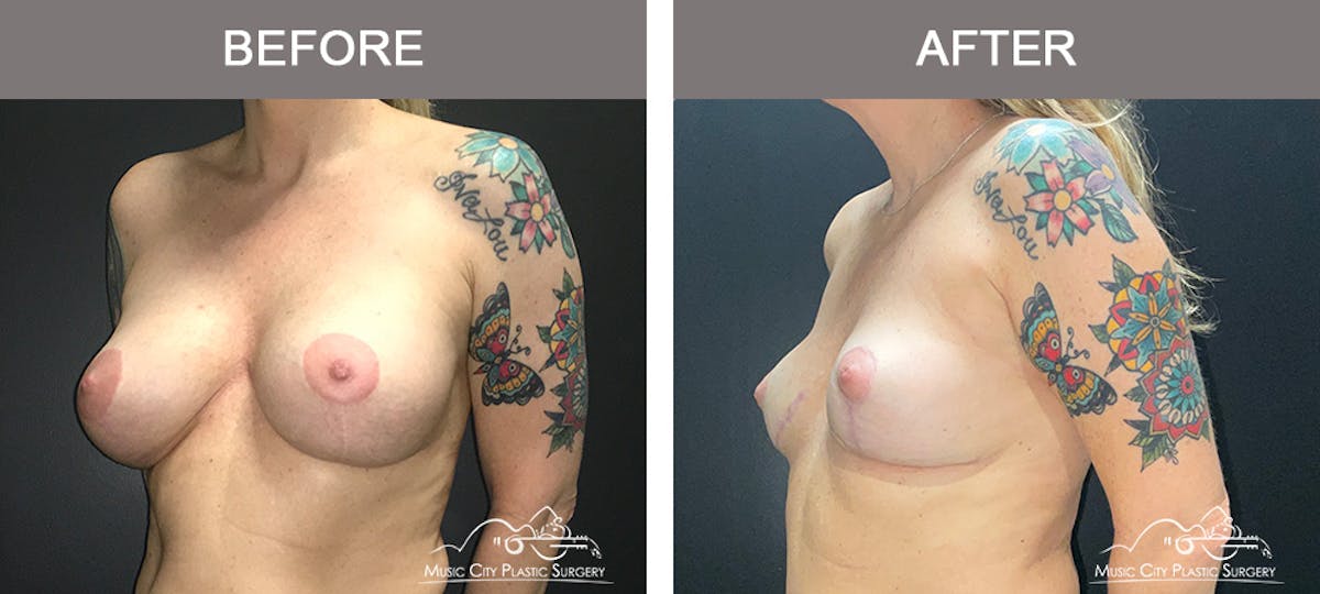 Breast Lift Before & After Gallery - Patient 353524 - Image 4