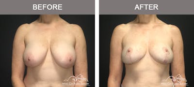 Breast Reduction Before & After Gallery - Patient 196616 - Image 1
