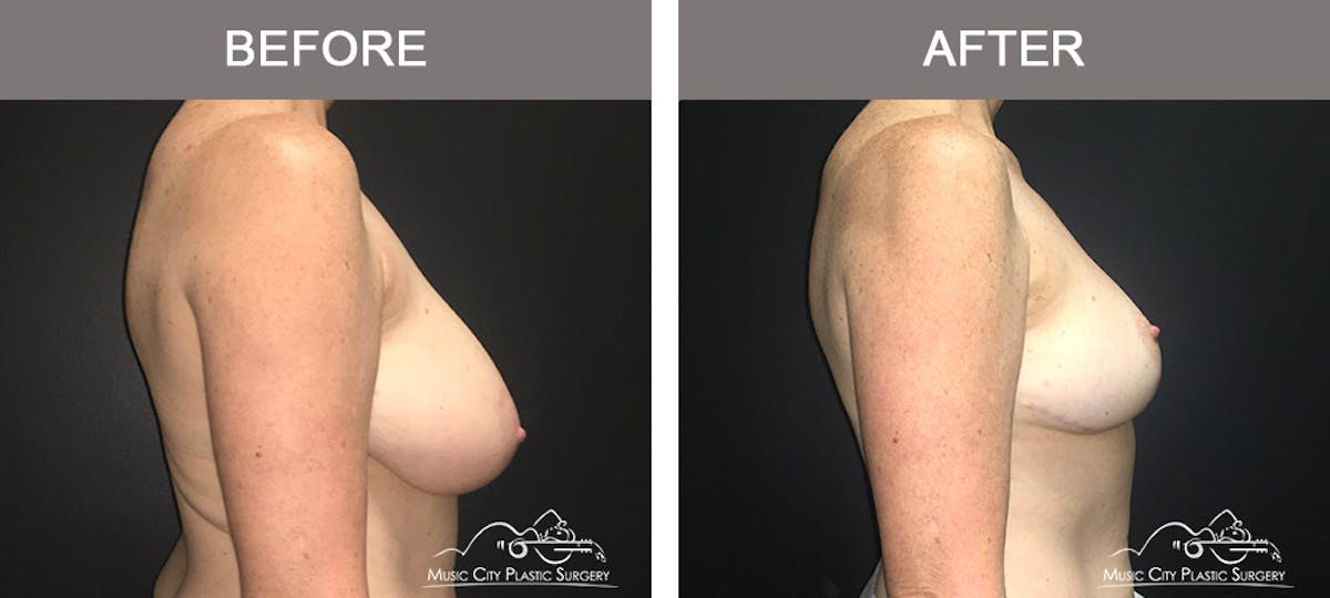 Breast Reduction Before & After Gallery - Patient 196616 - Image 3