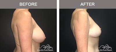 Breast Reduction Before & After Gallery - Patient 196616 - Image 3