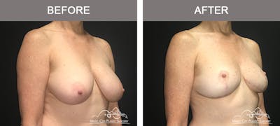 Breast Reduction Before & After Gallery - Patient 196616 - Image 2