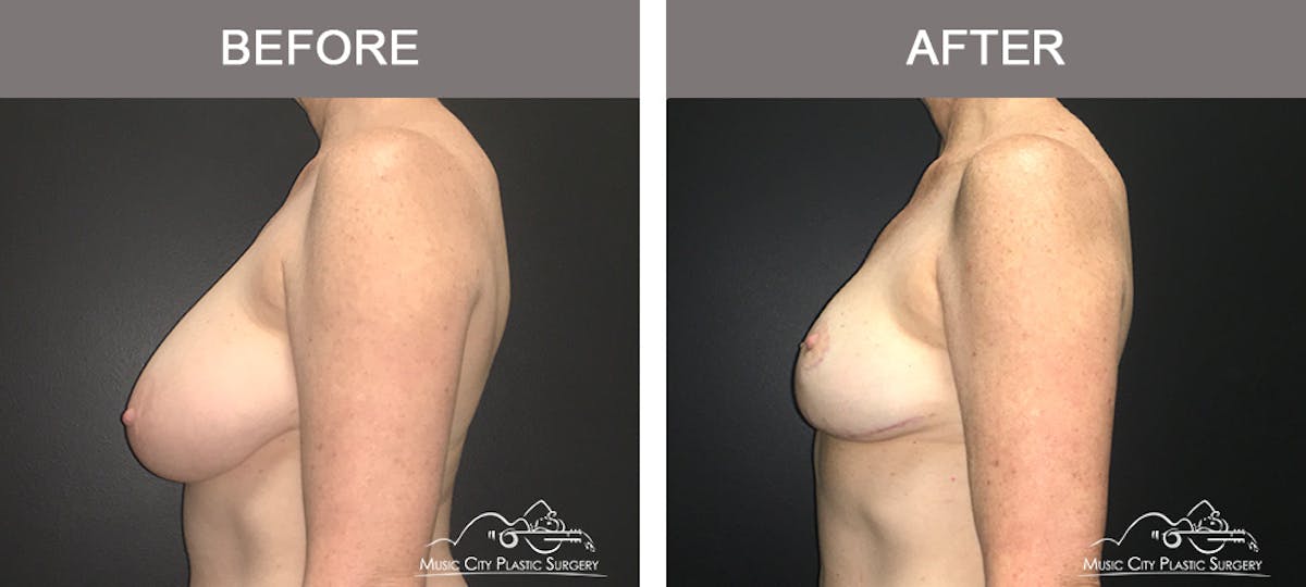 Breast Reduction Before & After Gallery - Patient 196616 - Image 5