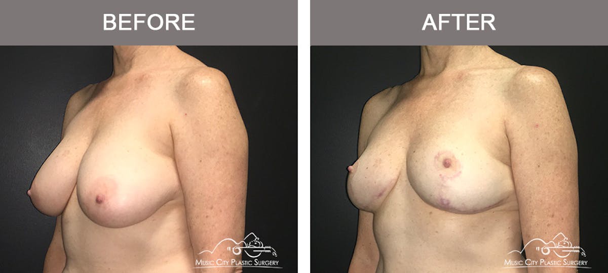 Breast Lift Before & After Gallery - Patient 165682 - Image 4