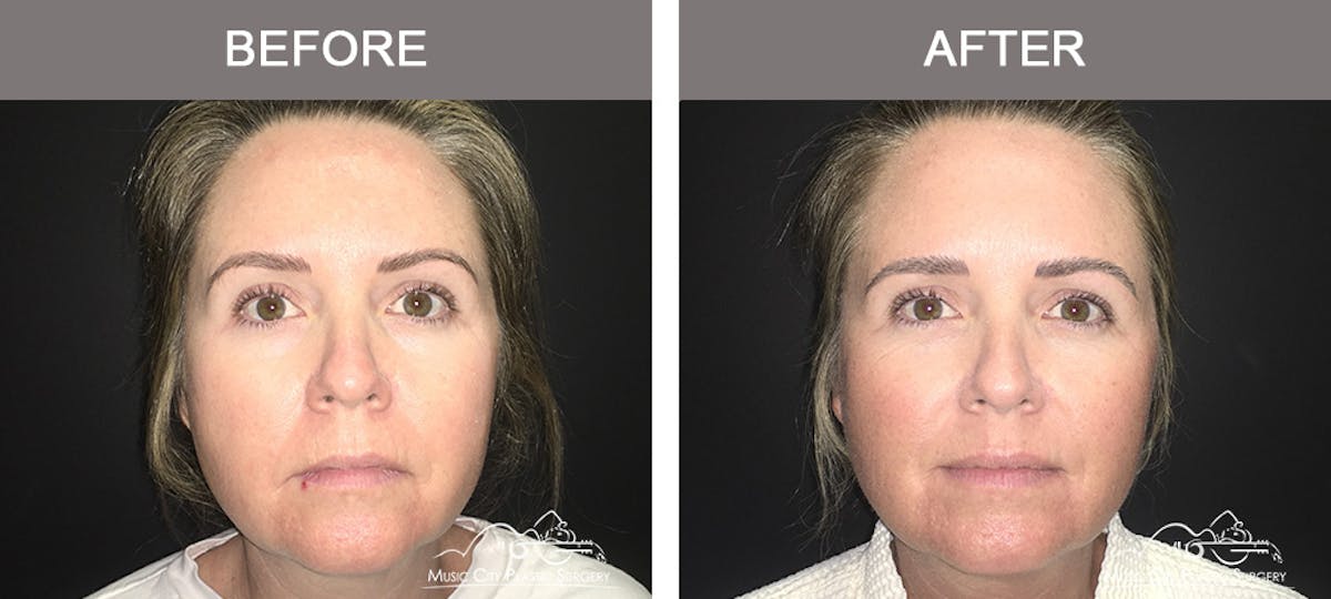 Dermal Fillers Before & After Gallery - Patient 123920 - Image 1