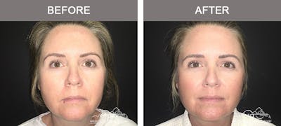 Dermal Fillers Before & After Gallery - Patient 123920 - Image 1