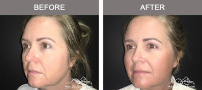Dermal Fillers Before & After Gallery - Patient 123920 - Image 2