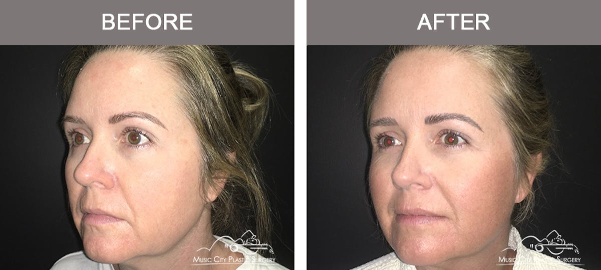 Dermal Fillers Before & After Gallery - Patient 123920 - Image 2