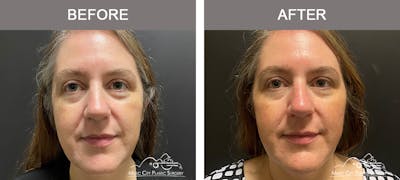 Dermal Fillers Before & After Gallery - Patient 715191 - Image 1