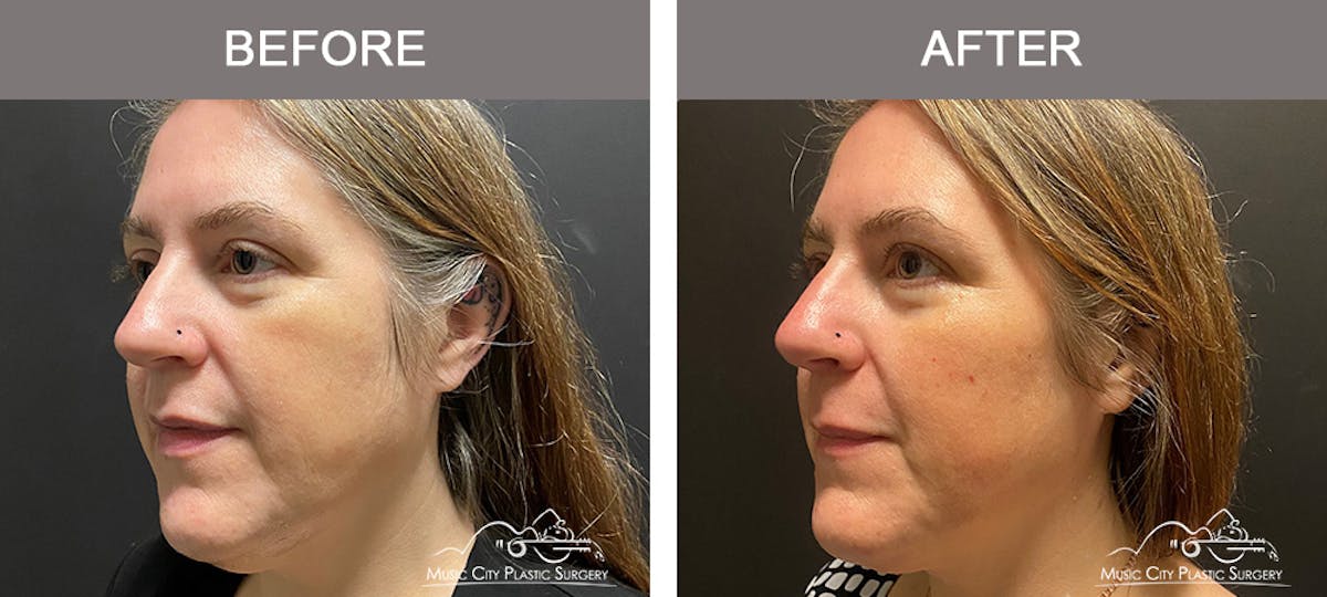 Dermal Fillers Before & After Gallery - Patient 715191 - Image 3