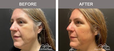 Dermal Fillers Before & After Gallery - Patient 715191 - Image 3