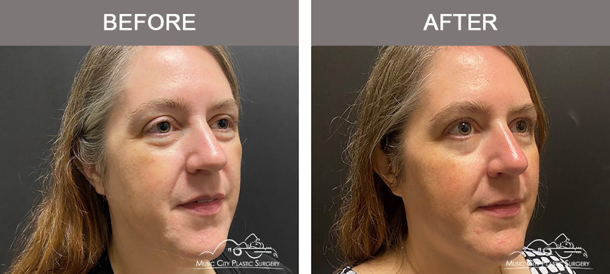 Dermal Fillers Before & After Gallery - Patient 715191 - Image 2