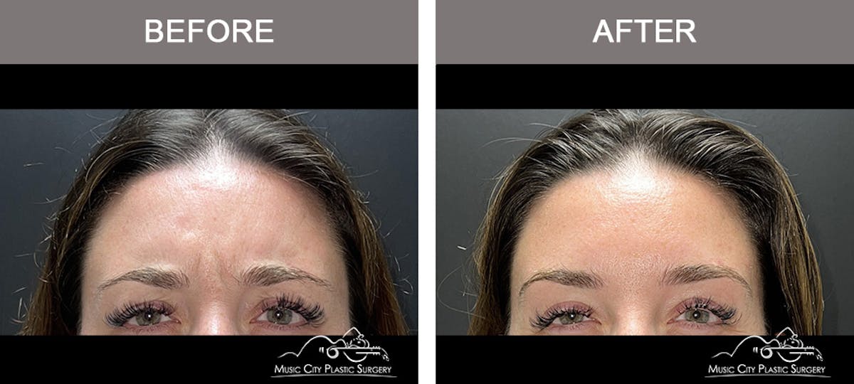 Dysport or Botox Before & After Gallery - Patient 601869 - Image 1
