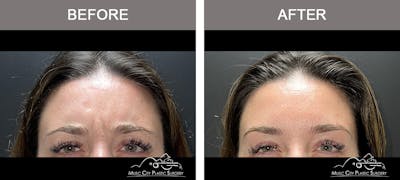 Dysport or Botox Before & After Gallery - Patient 601869 - Image 1