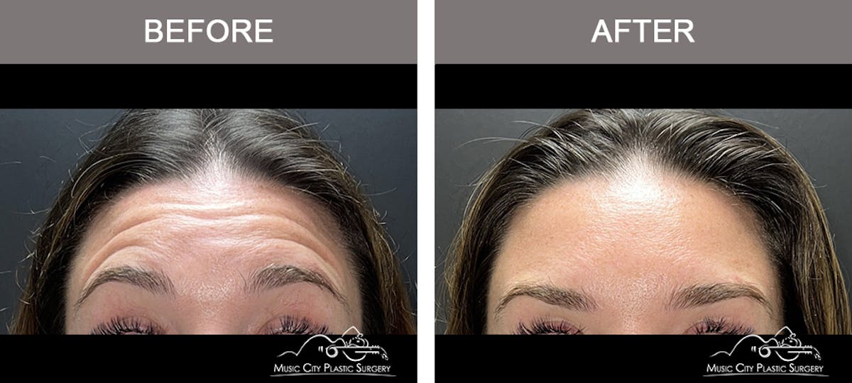 Dysport or Botox Before & After Gallery - Patient 601869 - Image 2