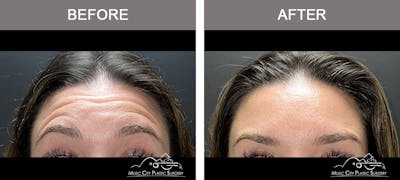 Dysport or Botox Before & After Gallery - Patient 601869 - Image 2