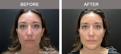 Thread Lifts Before & After Gallery - Patient 651175 - Image 1