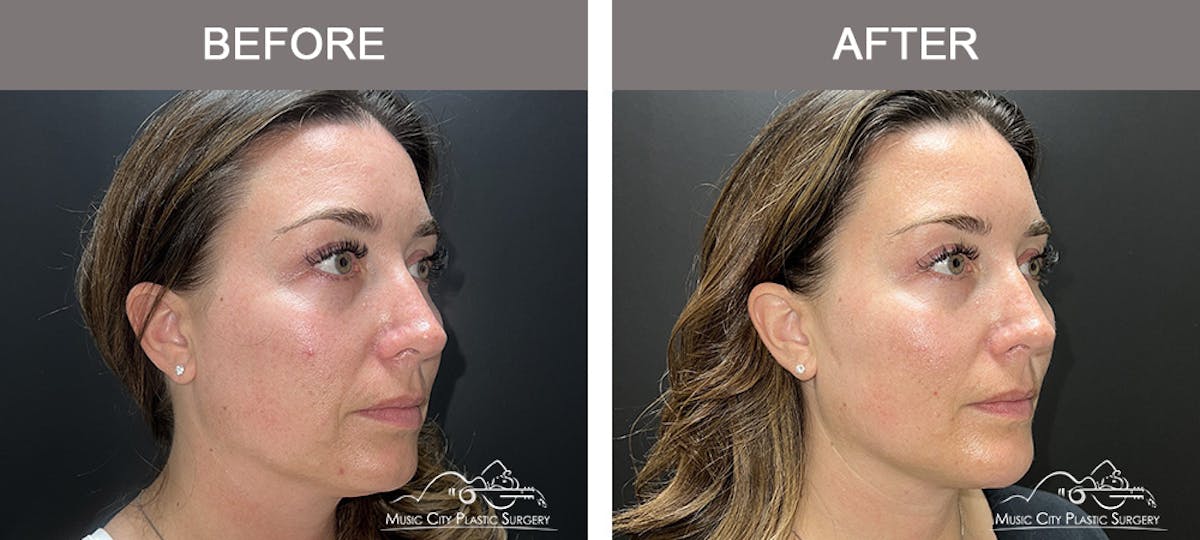 Thread Lifts Before & After Gallery - Patient 651175 - Image 2