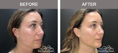 Thread Lifts Before & After Gallery - Patient 651175 - Image 2