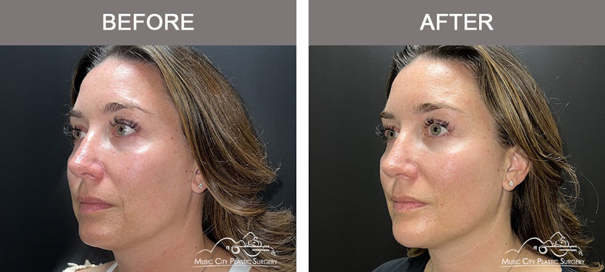 Thread Lifts Before & After Gallery - Patient 651175 - Image 3