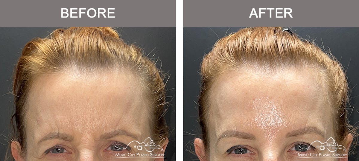 Dysport or Botox Before & After Gallery - Patient 369618 - Image 1