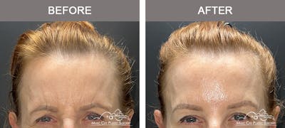 Dysport or Botox Before & After Gallery - Patient 369618 - Image 1