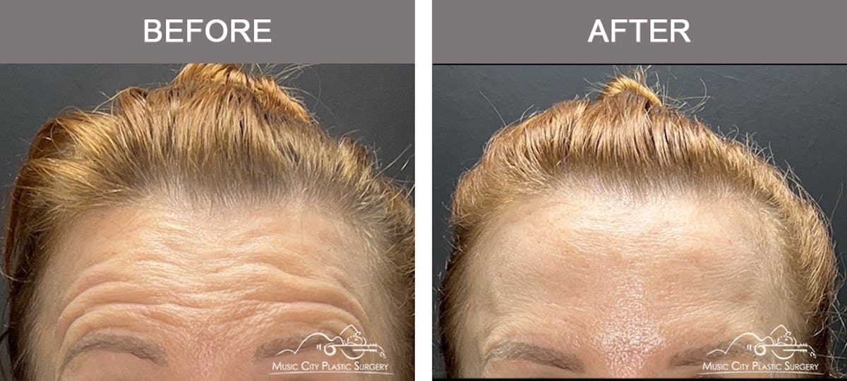 Dysport or Botox Before & After Gallery - Patient 369618 - Image 2