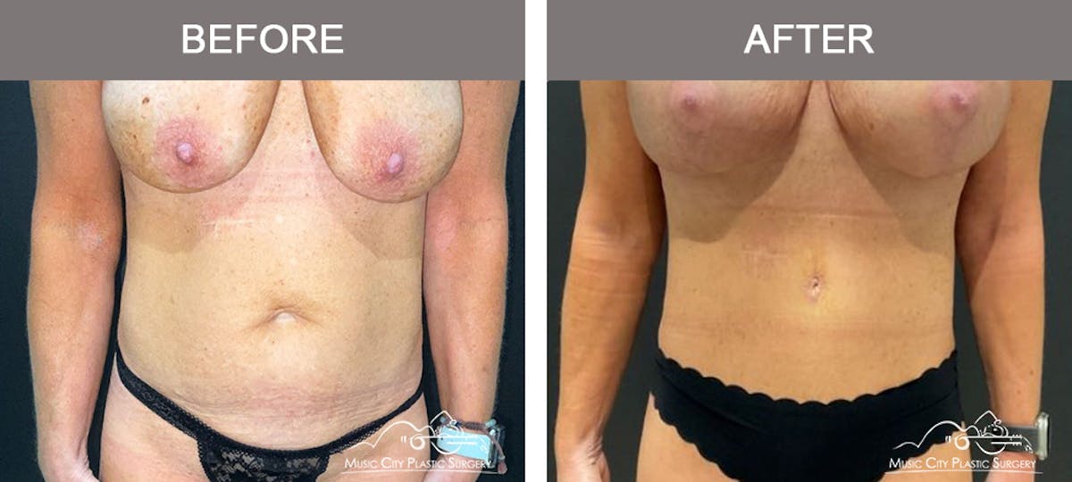 Abdominoplasty Before & After Gallery - Patient 312980 - Image 1